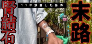 腎結石を11年放置した男の末路。